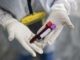 Super gonorrea resistente agli antibiotici e allarme in Europa