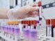 Test del sangue puo escludere rischio demenza fino a 10 anni prima lo studio