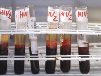Aids scoperti codici del sistema immunitario per sospendere le cure