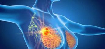 Cancro seno, campagna ‘In seno al futuro’ per aiutare le donne nel percorso di cura