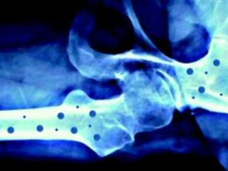 Il 20 ottobre 'Giornata mondiale dell’osteoporosi' 4 Il 20 ottobre Giornata mondiale dellosteoporosi
