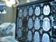 Telemedicina progetto telestroke permette di trattare ictus a distanza