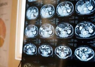 Neurologi Noi fondamentali in gestione neoplasie cerebrali