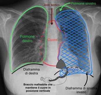 Tumore gli comprimeva cuore e polmone, salvato con complesso intervento alle Molinette