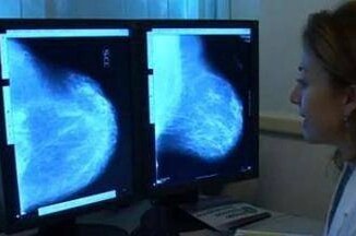 Donne operate per tumore al seno, 70% paga cure e 30% teme per il lavoro 2 Donne operate per tumore al seno 70 paga cure e 30 teme per il lavoro