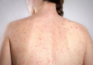 Morbillo la verita sulla vitamina A Non riduce il rischio di contrarre la malattia