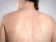 Morbillo la verita sulla vitamina A Non riduce il rischio di contrarre la malattia