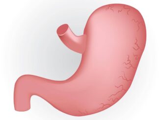 Caldo peggiora sintomi del reflusso in casi gravi chirurgia opzione risolutiva