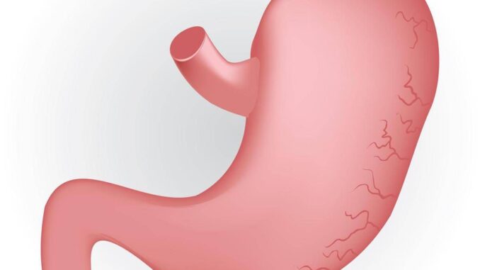 Caldo peggiora sintomi del reflusso, in casi gravi “chirurgia opzione risolutiva”