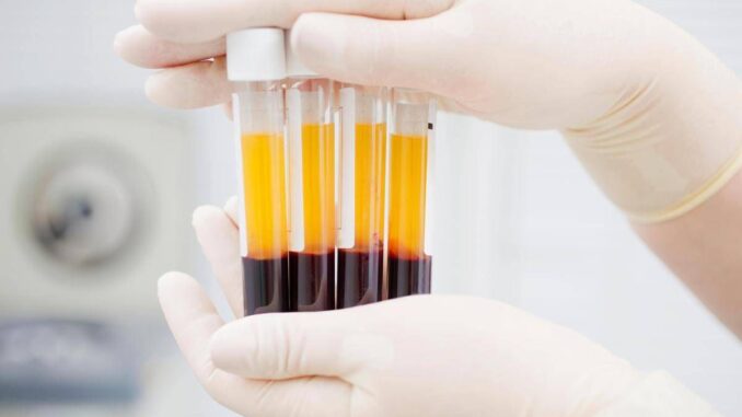 Plasmaderivati, Lecci (Sda Bocconi): “Serve un’innovazione rapida meno costosa”